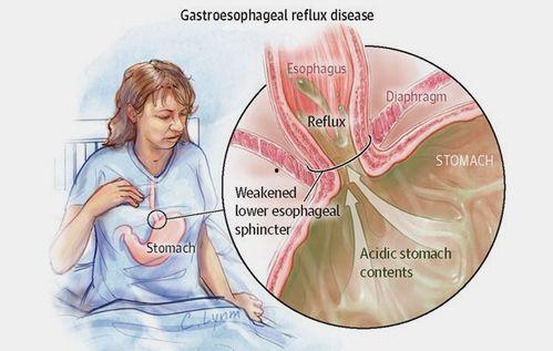吃甜的瓜辣的胃食道反酸