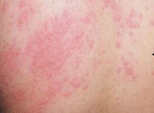 寻麻疹可以吃白瓜吗,白瓜的养生益处